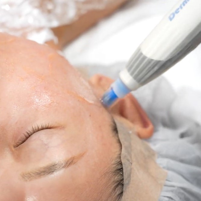 Nanofat Facial ｜BIANCA CLINIC in Tokyo, Japan