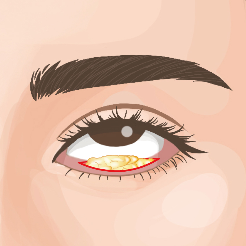Under Eye Fat Removal BIANCA in Tokyo, Japan