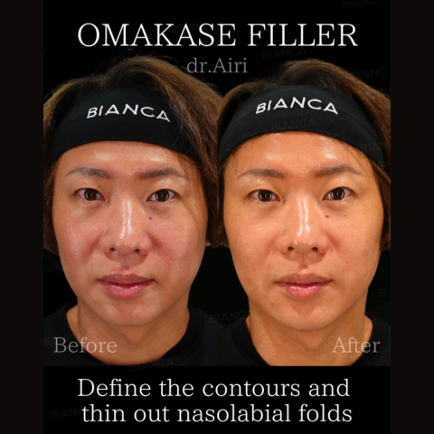 Filler / Hyaluronic acid injection BIANCA in Tokyo, Japan