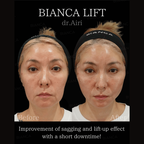 BIANCA LIFT（Thread Lift）BIANCA in Tokyo, Japan