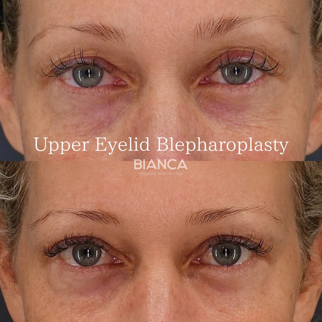 upper eyelid lift | eye surgery | Saiga