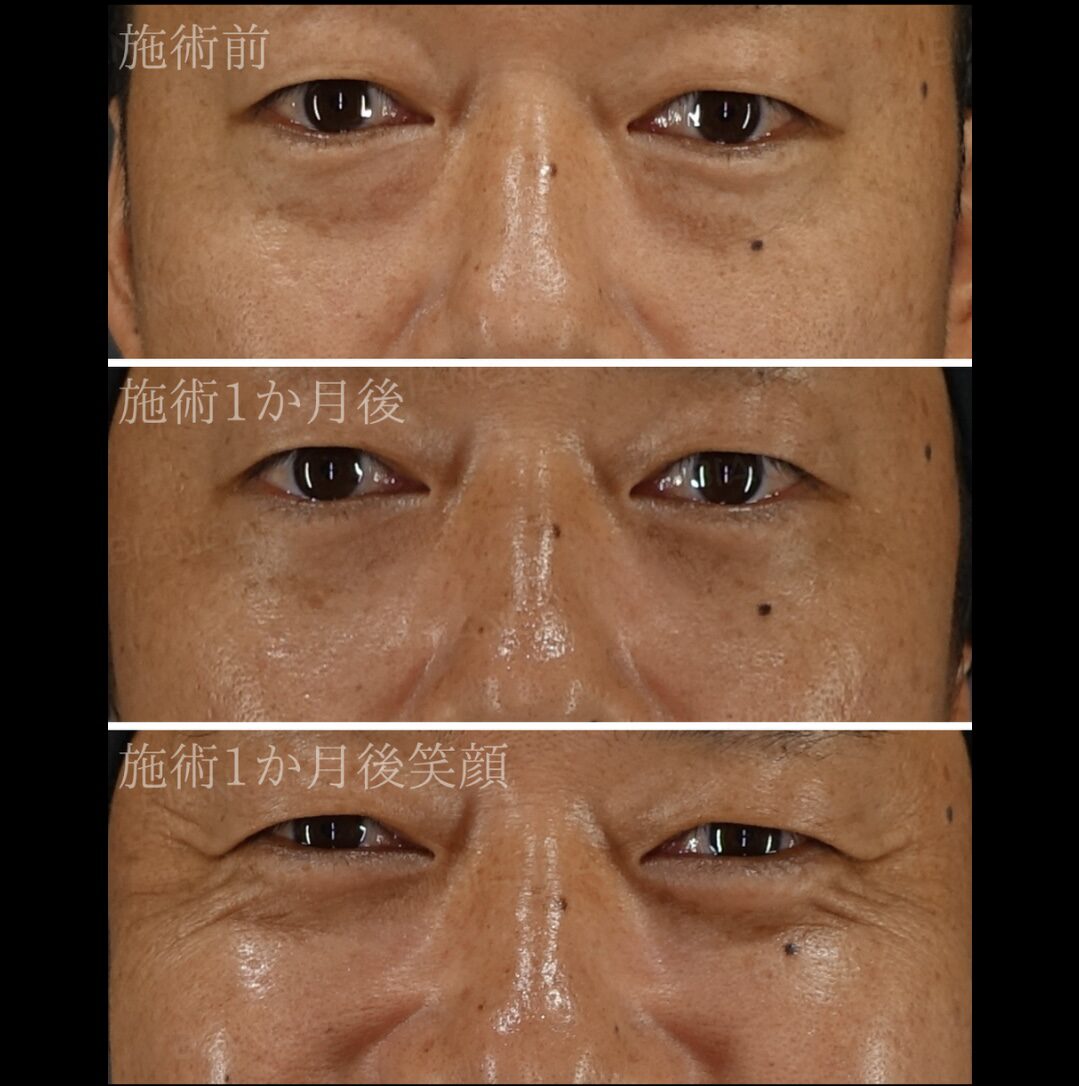 Under Eye Fat Removal BIANCA in Tokyo, Japan