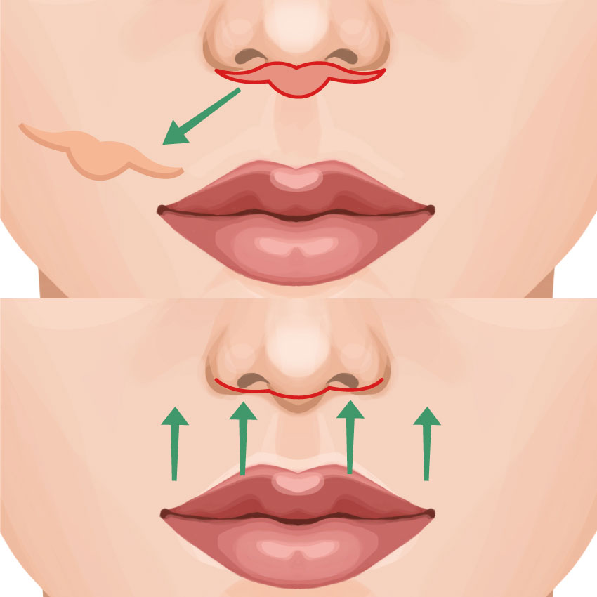 Lip Lift（Philtrum Shortening）