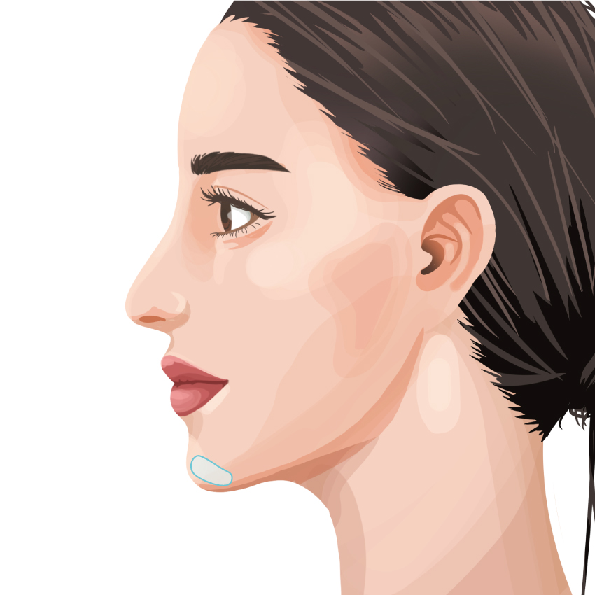 Jaw Prosthesis