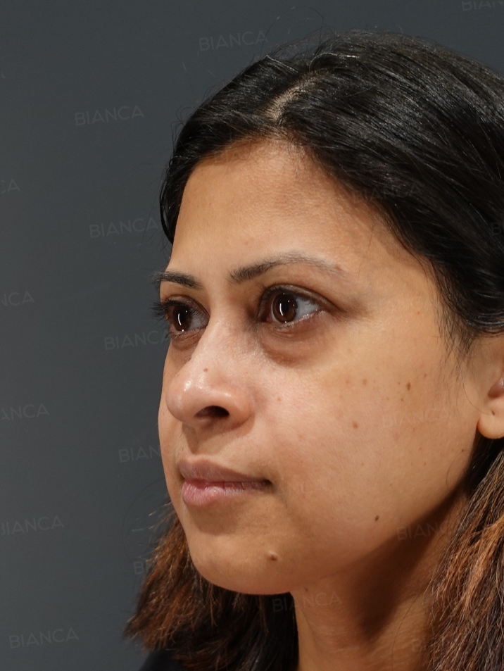 Baby Collagen + Hyaluronic Acid Injection for Under-Eye Dark Circles BIANCA in Tokyo, Japan