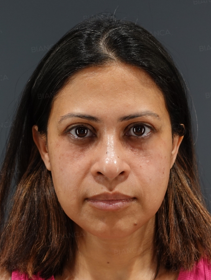Baby Collagen + Hyaluronic Acid Injection for Under-Eye Dark Circles BIANCA in Tokyo, Japan