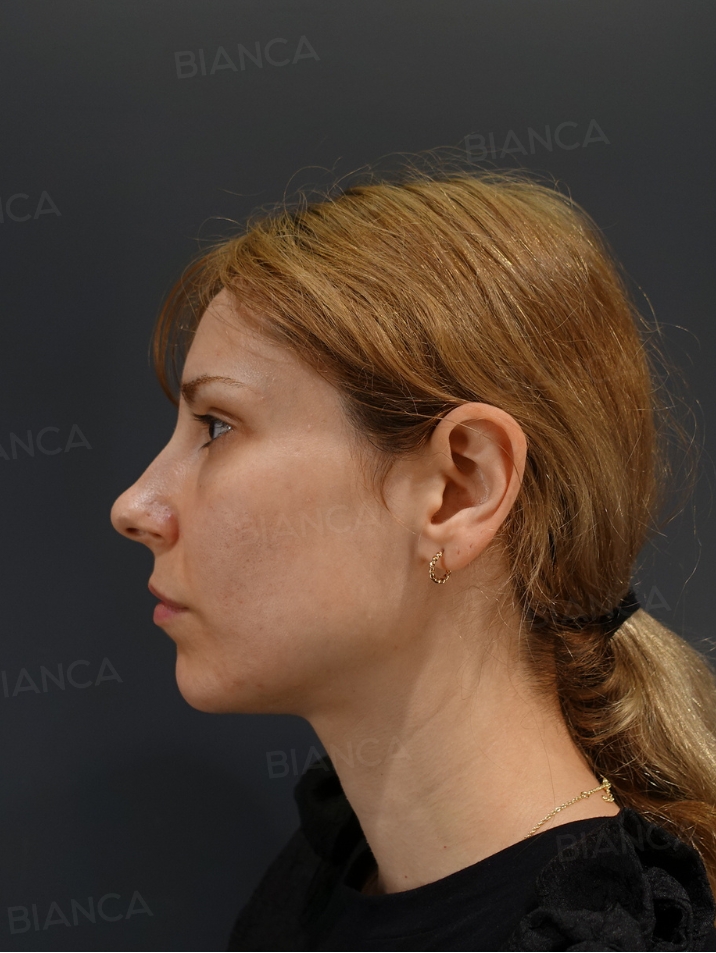 Side View Before