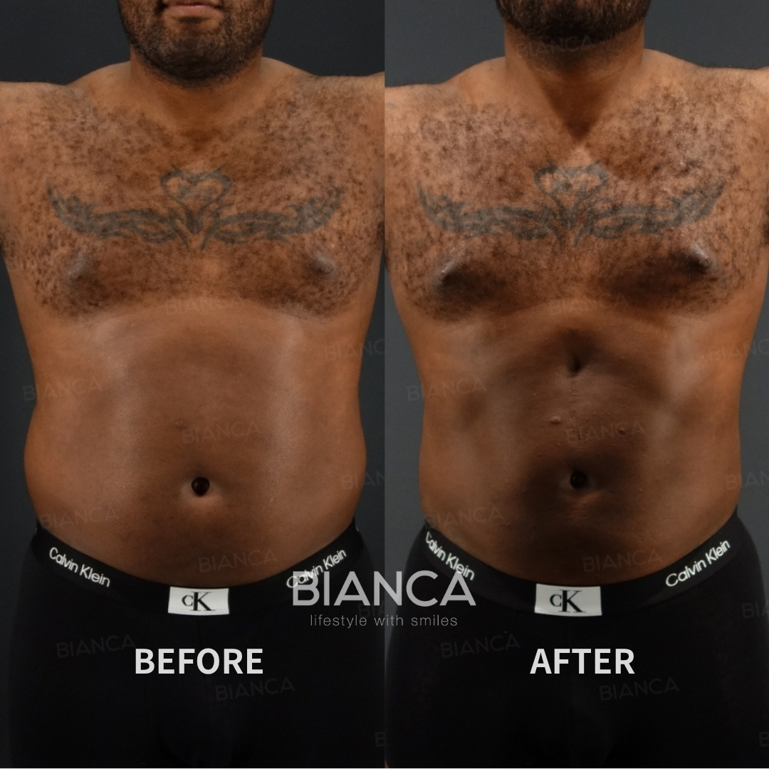 Left image: Before treatment / Right image: 1 month after Treatment details: VASER liposuction (abdominal etching / ab crack formation) Cost (This will be self-funded treatment): ¥1,210,000 (tax inc.) Risks / side effects: Lump, asymmetry, hematoma, irregularities, infection, etc.