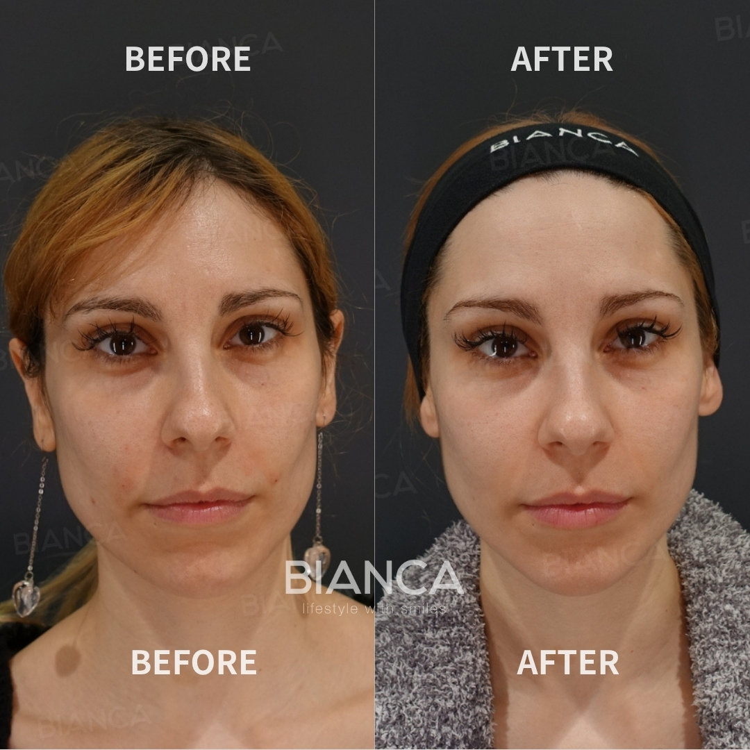 Left image: Before treatment / Right image: Just after Treatment details: Hyaluronic acid filler (nasolabial folds), Juvederm VOLIFT (1 mL), Microcannula Cost (This will be self-funded treatment): ¥111,320 (tax inc.) Risks / side effects: Lump, asymmetry, hematoma, irregularities, infection, etc.