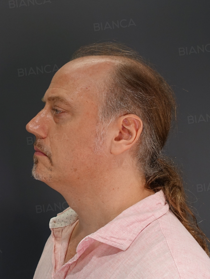 Side View After