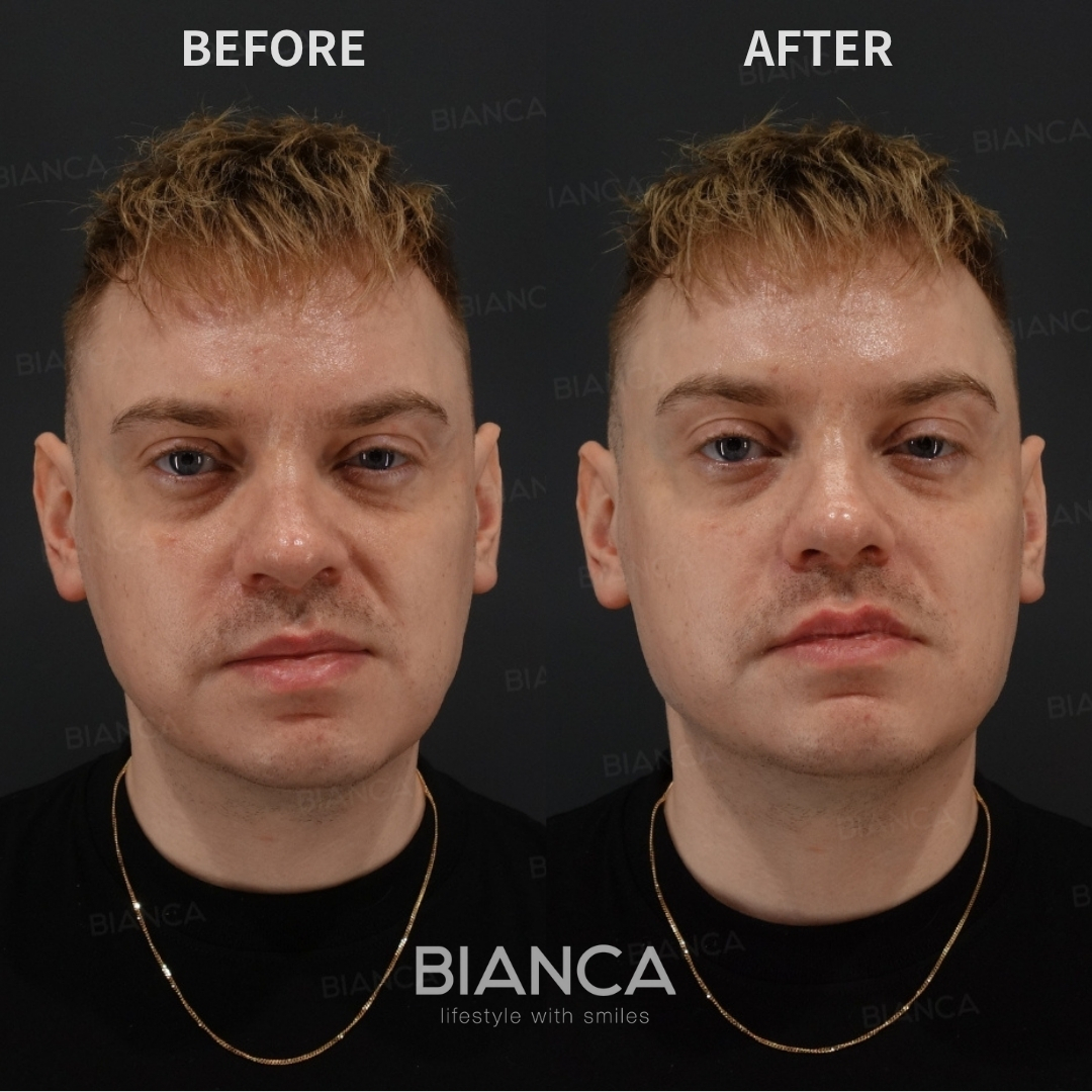 Left image: Before treatment / Right image: Just after Treatment details: Hyaluronic acid filler (lips), Hyaluronic acid filler (jawline), Microcannula Cost (This will be self-funded treatment): ¥196,020 (tax inc.) Risks / side effects: Lump, asymmetry, hematoma, irregularities, infection, etc.