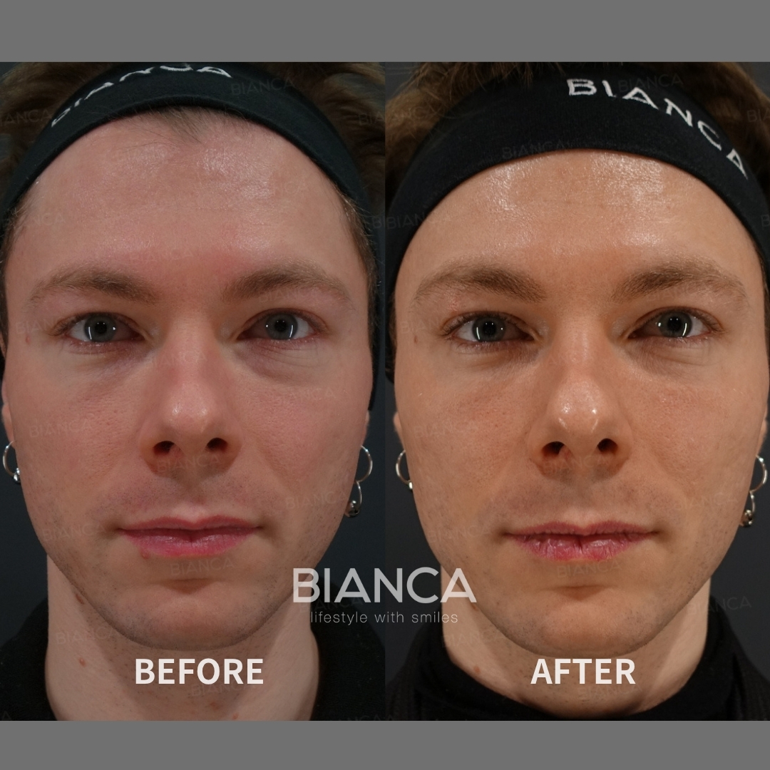 Left image: Before treatment / Right image: 1 month after Treatment details: Juvelook injection (full face) Cost (This will be self-funded treatment): ¥110,000 (tax inc.) Risks / side effects: Lump, asymmetry, hematoma, irregularities, infection, etc.