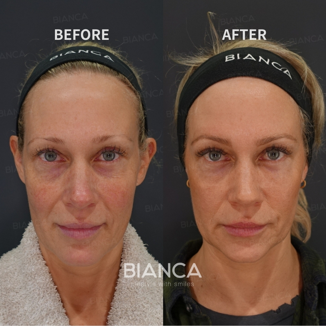 Left image: Before treatment / Right image: 1 month after Treatment details: Lower blepharoplasty (Hamra method fat repositioning) Cost (This will be self-funded treatment): ¥602,580 (tax inc.) Risks / side effects: Lump, asymmetry, hematoma, irregularities, infection, etc.