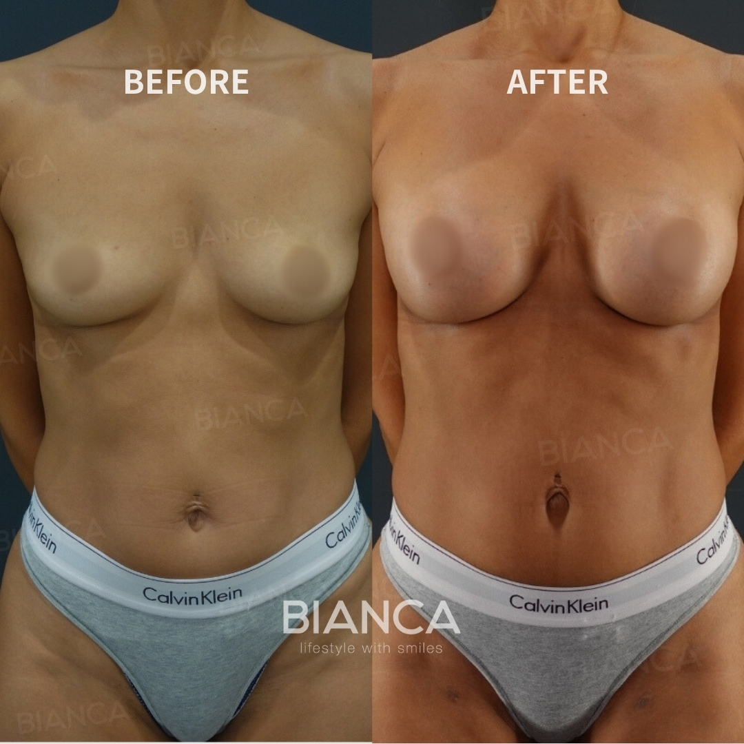 Left image: Before treatment / Right image: 6 months after Treatment details: Hybrid breast augmentation (silicone implants, CRF fat transfer) Cost (This will be self-funded treatment): ¥1,760,000 (tax inc.) Risks / side effects: Lump, asymmetry, hematoma, irregularities, infection, etc.