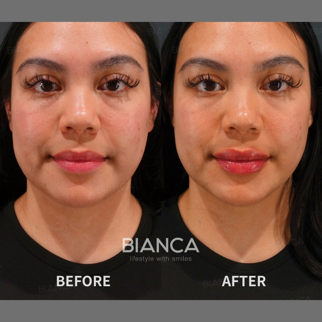 Left image: Before treatment / Right image: 1 month after Treatment details: Hyaluronic acid filler (lips), Juvederm VOLBELLA Cost (This will be self-funded treatment): ¥108,900 (tax inc.) Risks / side effects: Lump, asymmetry, hematoma, irregularities, infection, etc.
