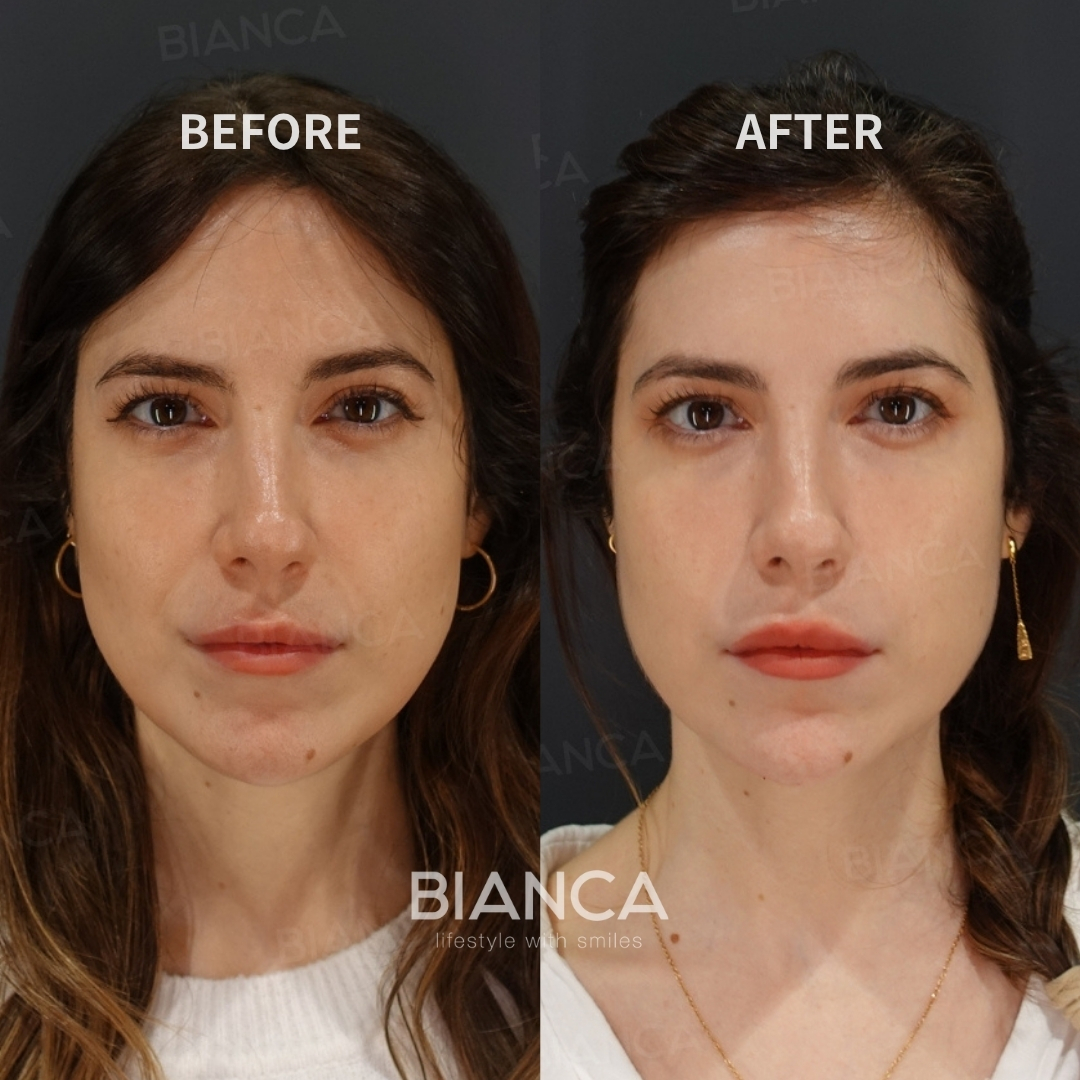 Left image: Before treatment / Right image: Just after Treatment details: Hyaluronic acid filler (chin), Restylane Lyft Cost (This will be self-funded treatment): ¥108,900 (tax inc.) Risks / side effects: Lump, asymmetry, hematoma, irregularities, infection, etc.