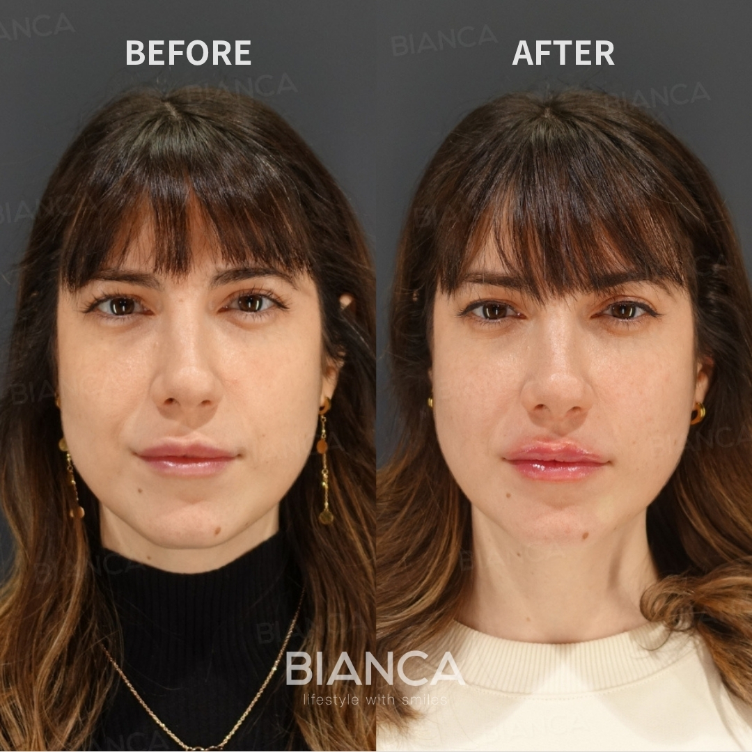 Left image: Before treatment / Right image: Just after Treatment details: Hyaluronic acid filler (lips) Cost (This will be self-funded treatment): ¥108,900 (tax inc.) Risks / side effects: Lump, asymmetry, hematoma, irregularities, infection, etc.