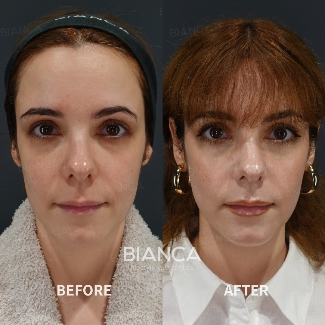 Left image: Before treatment / Right image: 2 weeks after Treatment details: Hyaluronic acid filler (lips), Juvederm VOLBELLA, Microcannula Cost (This will be self-funded treatment): ¥111,320 (tax inc.) Risks / side effects: Lump, asymmetry, hematoma, irregularities, infection, etc.