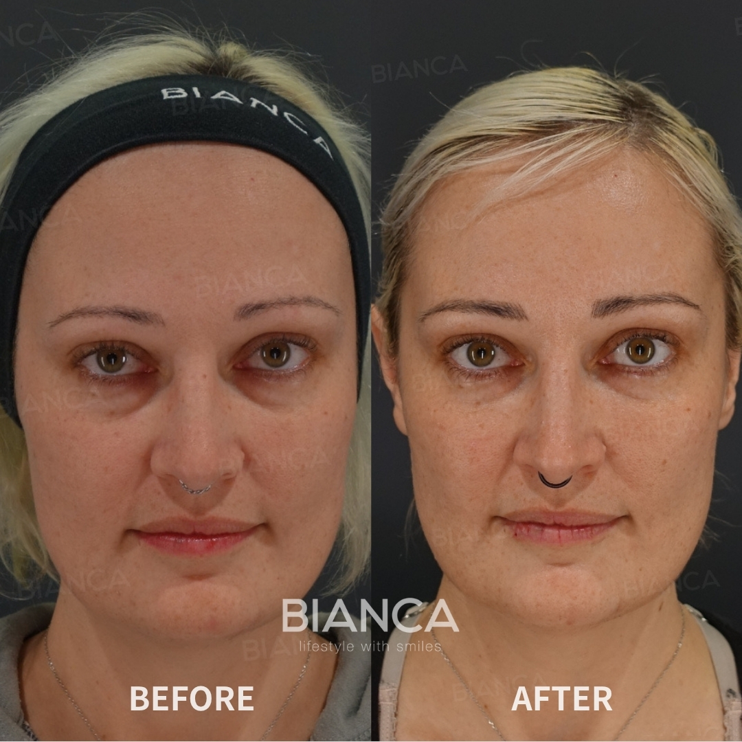 Left image: Before treatment / Right image: 1 month after Treatment details: Hyaluronic acid filler (under eyes), Juvederm VOLUMA XC Cost (This will be self-funded treatment): ¥108,900 (tax inc.) Risks / side effects: Lump, asymmetry, hematoma, irregularities, infection, etc.