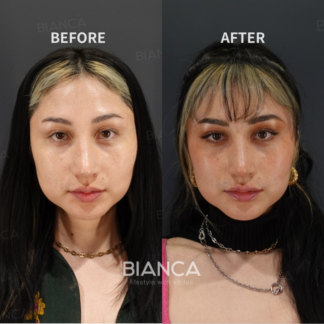 Left image: Before treatment / Right image: 1 month after Treatment details: Rejuran skin booster (full face) Cost (This will be self-funded treatment): ¥77,000 (tax inc.) Risks / side effects: Lump, asymmetry, hematoma, irregularities, infection, etc.