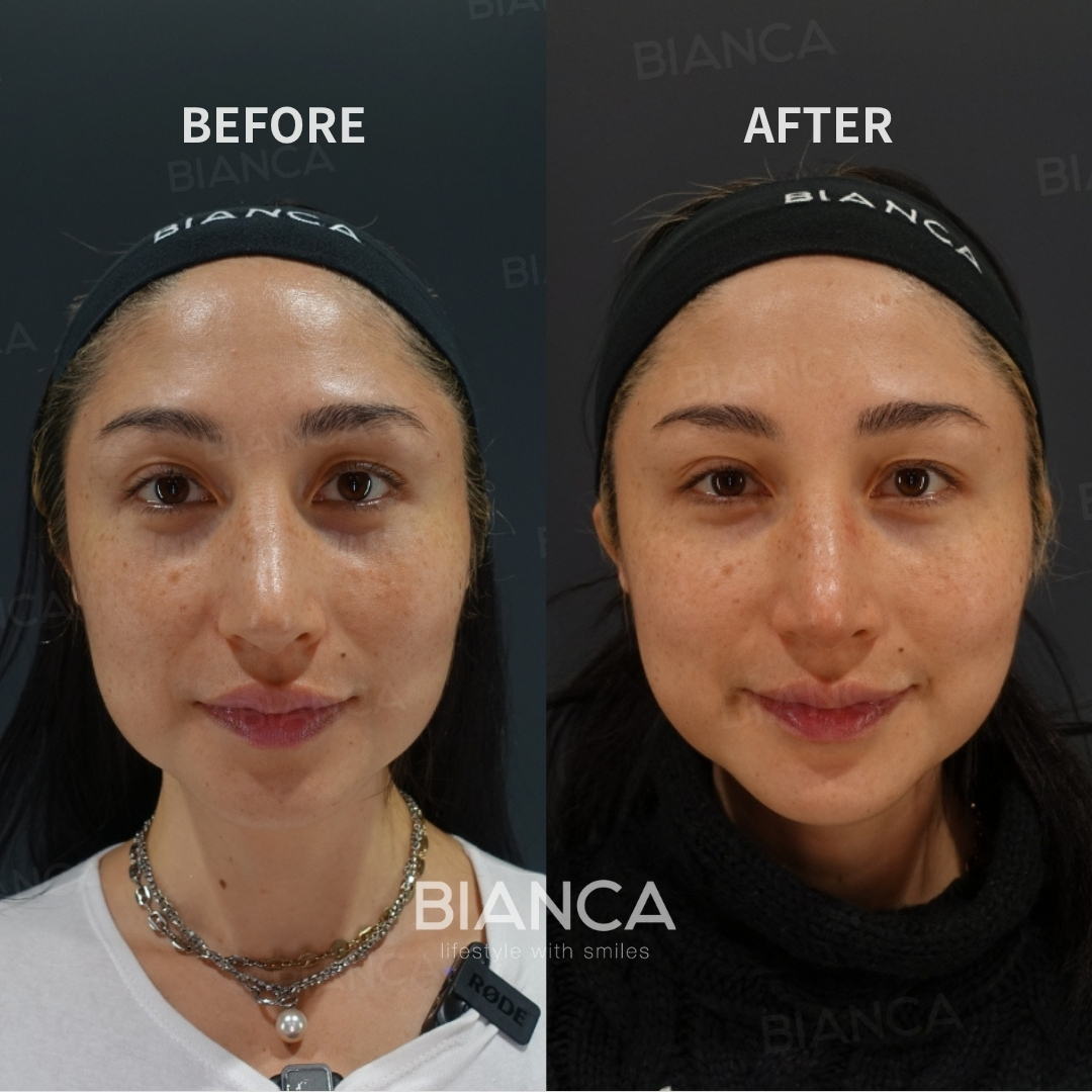Left image: Before treatment / Right image: Just after Treatment details: Jebellook Volume (Lenysna) under eyes, Jebellook Volume (Lenysna) nasolabial folds Cost (This will be self-funded treatment): ¥110,000 (tax inc.) Risks / side effects: Lump, asymmetry, hematoma, irregularities, infection, etc.