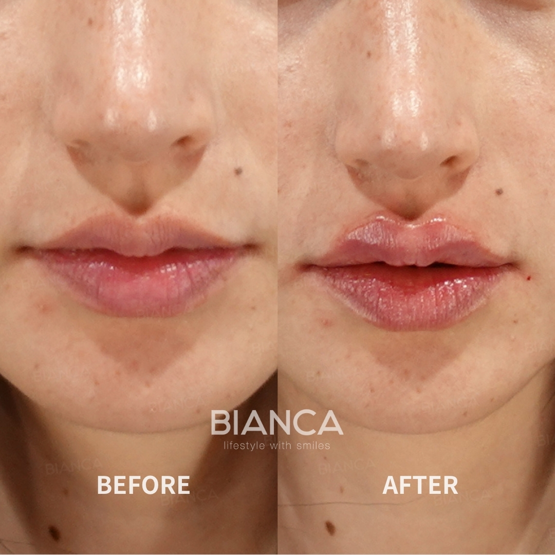 Left image: Before treatment / Right image: 2 weeks after Treatment details: Hyaluronic acid filler (lips), Juvederm VOLBELLA Cost (This will be self-funded treatment): ¥108,900 (tax inc.) Risks / side effects: Lump, asymmetry, hematoma, irregularities, infection, etc.