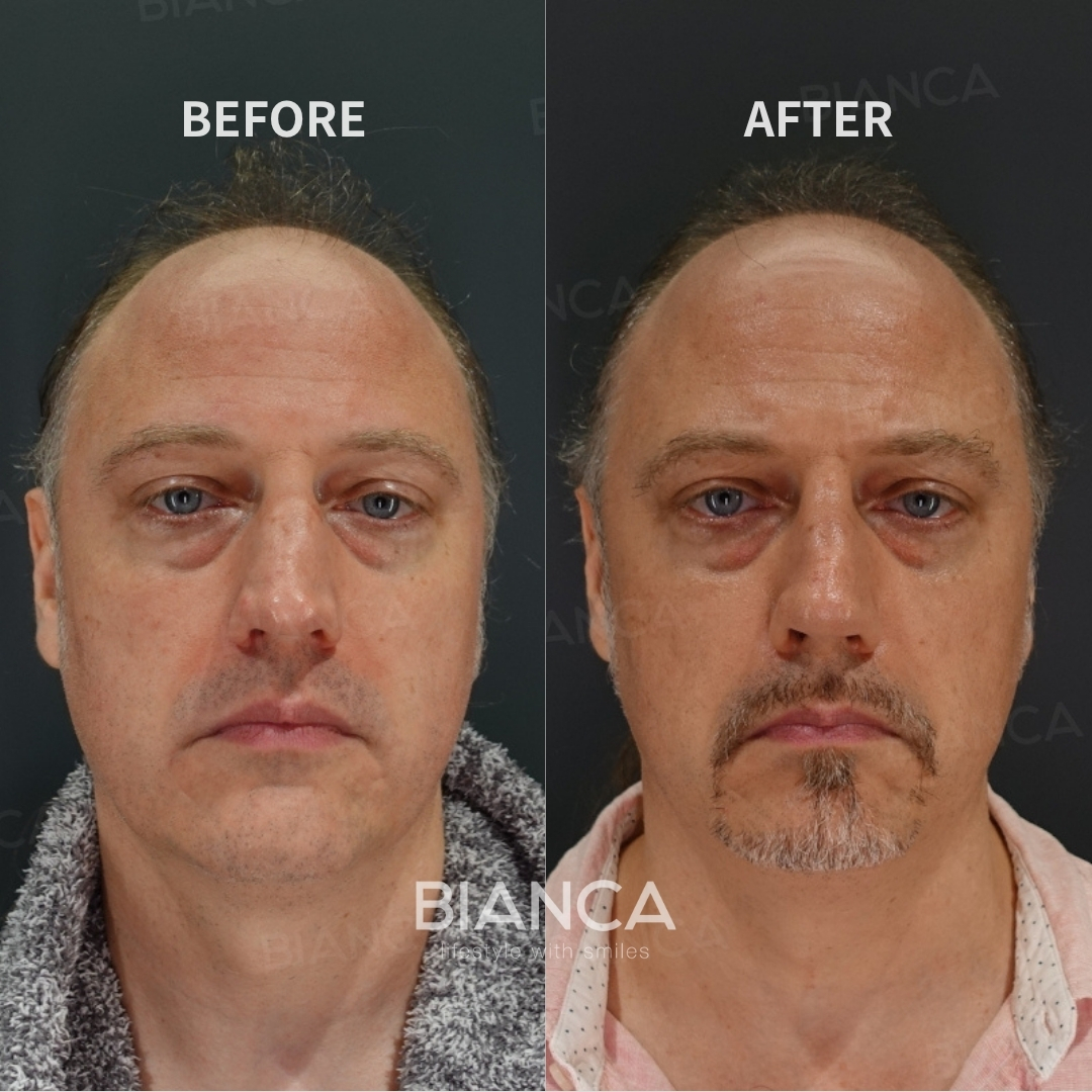 Left image: Before treatment / Right image: 6 months after Treatment details: Nasal tip reduction, Dorsal hump reduction (hump shaving), Nasal bone osteotomy (medialization), Columella strut (nasal tip formation) Cost (This will be self-funded treatment): ¥1,210,000 (tax inc.) Risks / side effects: Lump, asymmetry, hematoma, irregularities, infection, etc.