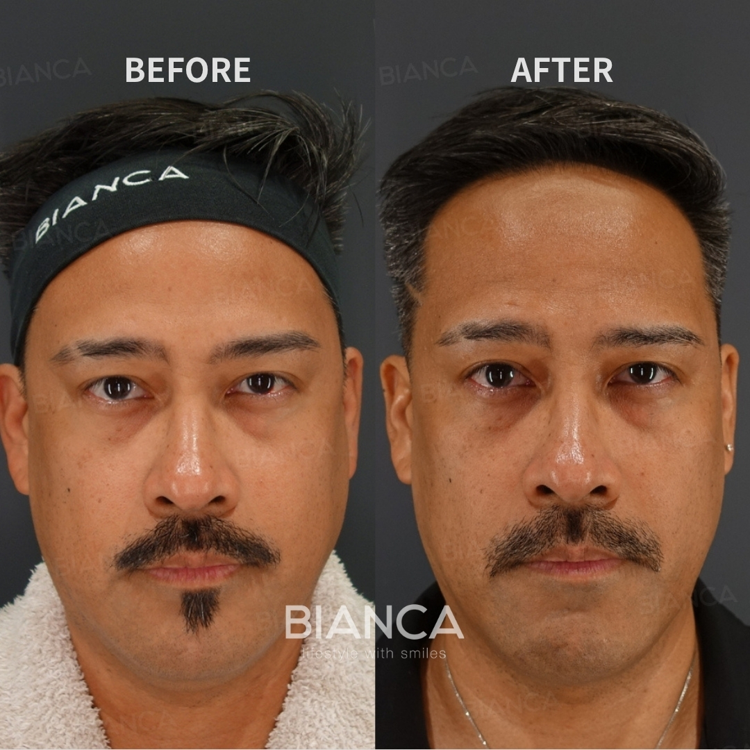 Left image: Before treatment / Right image: Just after Treatment details: Morpheus8 (face), EmbraceRF (face), Submental liposuction (under chin) Cost (This will be self-funded treatment): ¥412,500 (tax inc.) Risks / side effects: Lump, asymmetry, hematoma, irregularities, infection, etc.