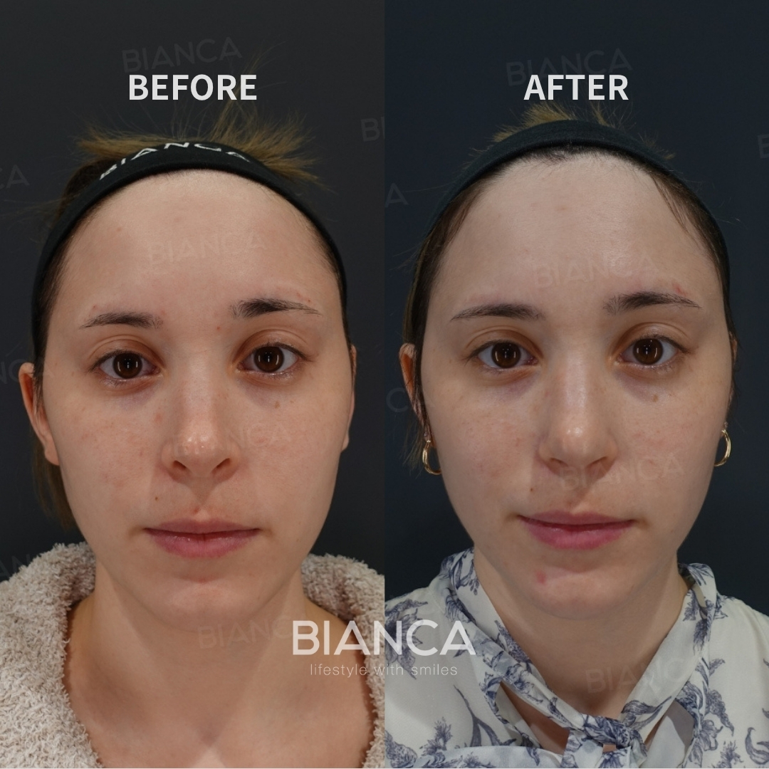 Left image: Before treatment / Right image: 6 months after Treatment details: Nasal bone osteotomy, Nasal tip shaping, Alar rim reduction, Open rhinoplasty with auricular cartilage graft Cost (This will be self-funded treatment): ¥1,155,000 (tax inc.) Risks / side effects: Lump, asymmetry, hematoma, irregularities, infection, etc.
