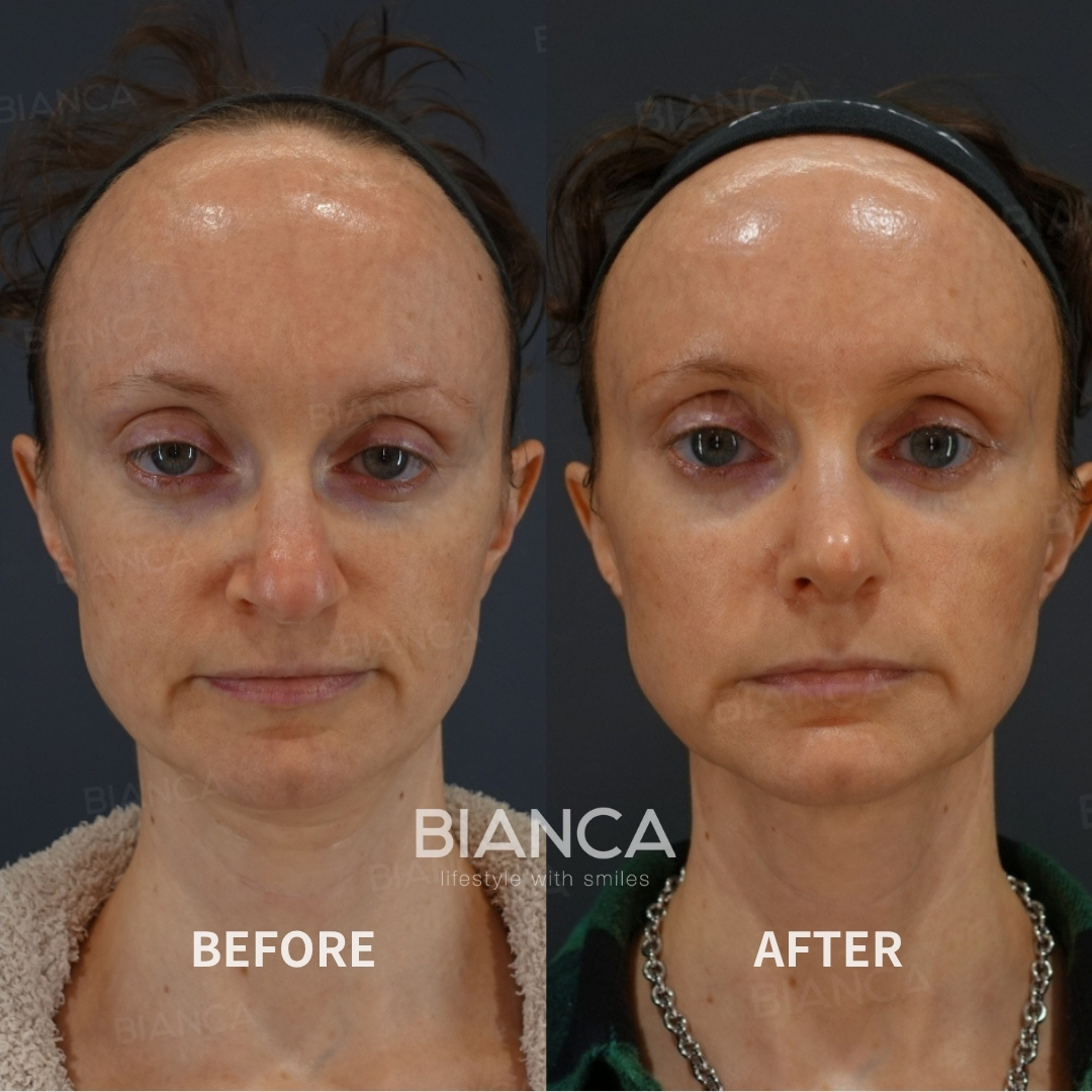 Left image: Before treatment / Right image: 6 months after Treatment details: Nasal tip shaping, Nasal tip cartilage graft, Rhinoplasty (columella strut technique), Nasal tip reduction, BIANCA Lift Cost (This will be self-funded treatment): ¥1,364,000 (tax inc.) Risks / side effects: Lump, asymmetry, hematoma, irregularities, infection, etc.