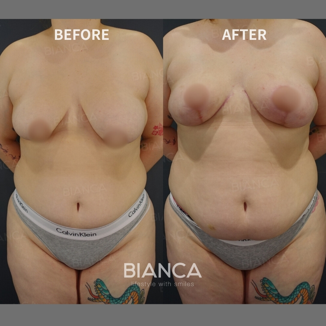 Left image: Before treatment / Right image: 6 months after Treatment details: Breast lift (mastopexy) Cost (This will be self-funded treatment): ¥1,210,000 (tax inc.) Risks / side effects: Lump, asymmetry, hematoma, irregularities, infection, etc.