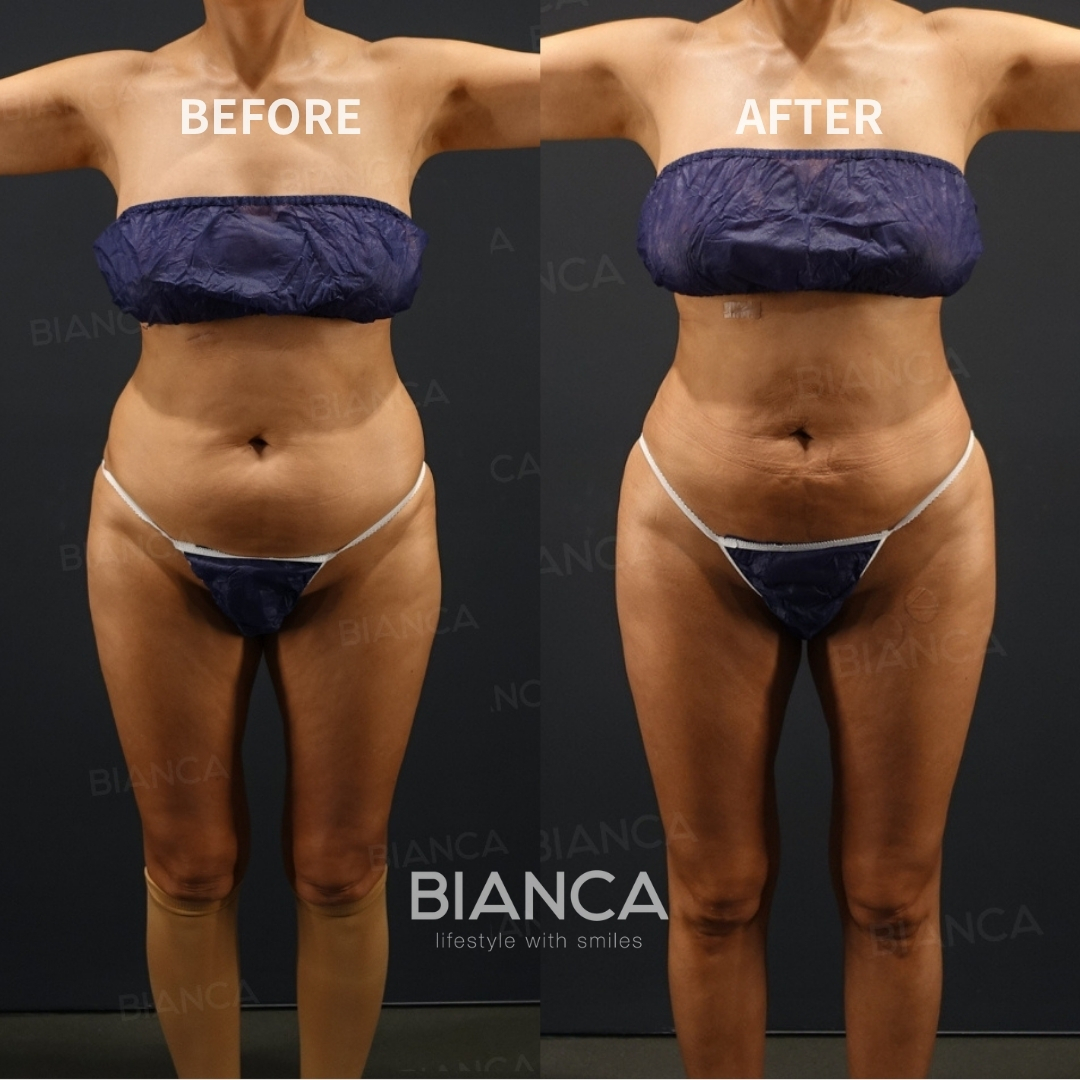 Left image: Before treatment / Right image: 3 months after Treatment details: Brazilian butt lift (autologous fat transfer), VASER liposuction (abdomen, flanks, lower back) Cost (This will be self-funded treatment): ¥1,210,000 (tax inc.) Risks / side effects: Lump, asymmetry, hematoma, irregularities, infection, etc.