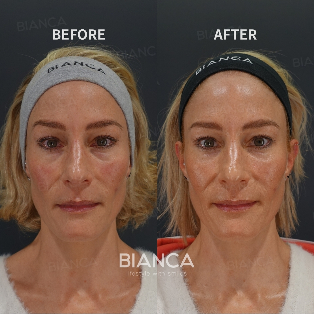 Left image: Before treatment / Right image: 2 weeks after Treatment details: Baby collagen (under eyes), Microcannula Cost (This will be self-funded treatment): ¥145,200 (tax inc.) Risks / side effects: Lump, asymmetry, hematoma, irregularities, infection, etc.