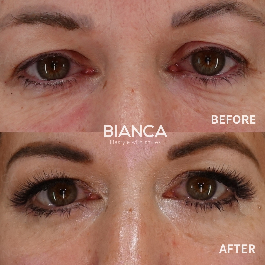 Left image: Before treatment / Right image: 1 month after Treatment details: Upper blepharoplasty, Morpheus8 (around eyes) Cost (This will be self-funded treatment): ¥437,580 (tax inc.) Risks / side effects: Lump, asymmetry, hematoma, irregularities, infection, etc.
