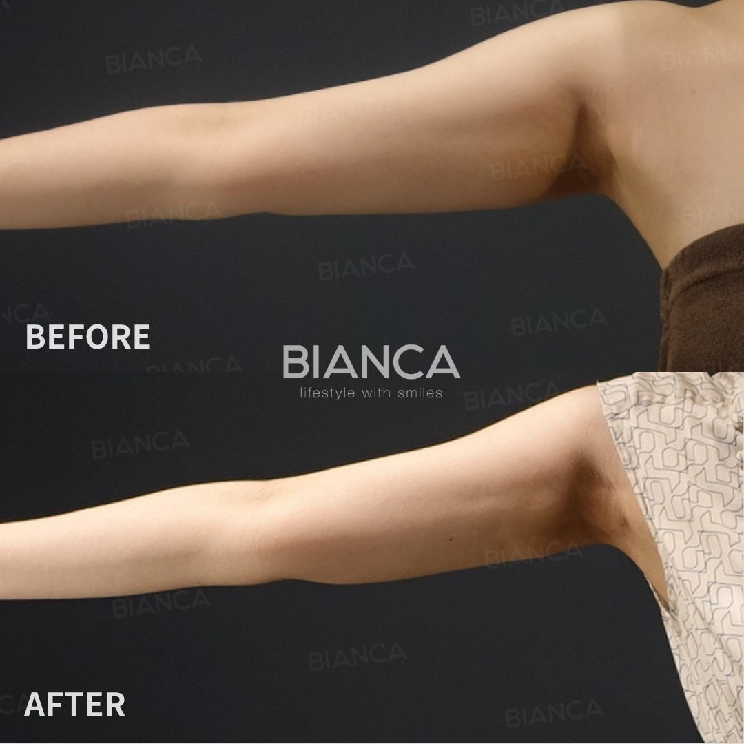 Left image: Before treatment / Right image: 1 month after Treatment details: VASER liposuction (upper arms) Cost (This will be self-funded treatment): ¥275,000 (tax inc.) Risks / side effects: Lump, asymmetry, hematoma, irregularities, infection, etc.