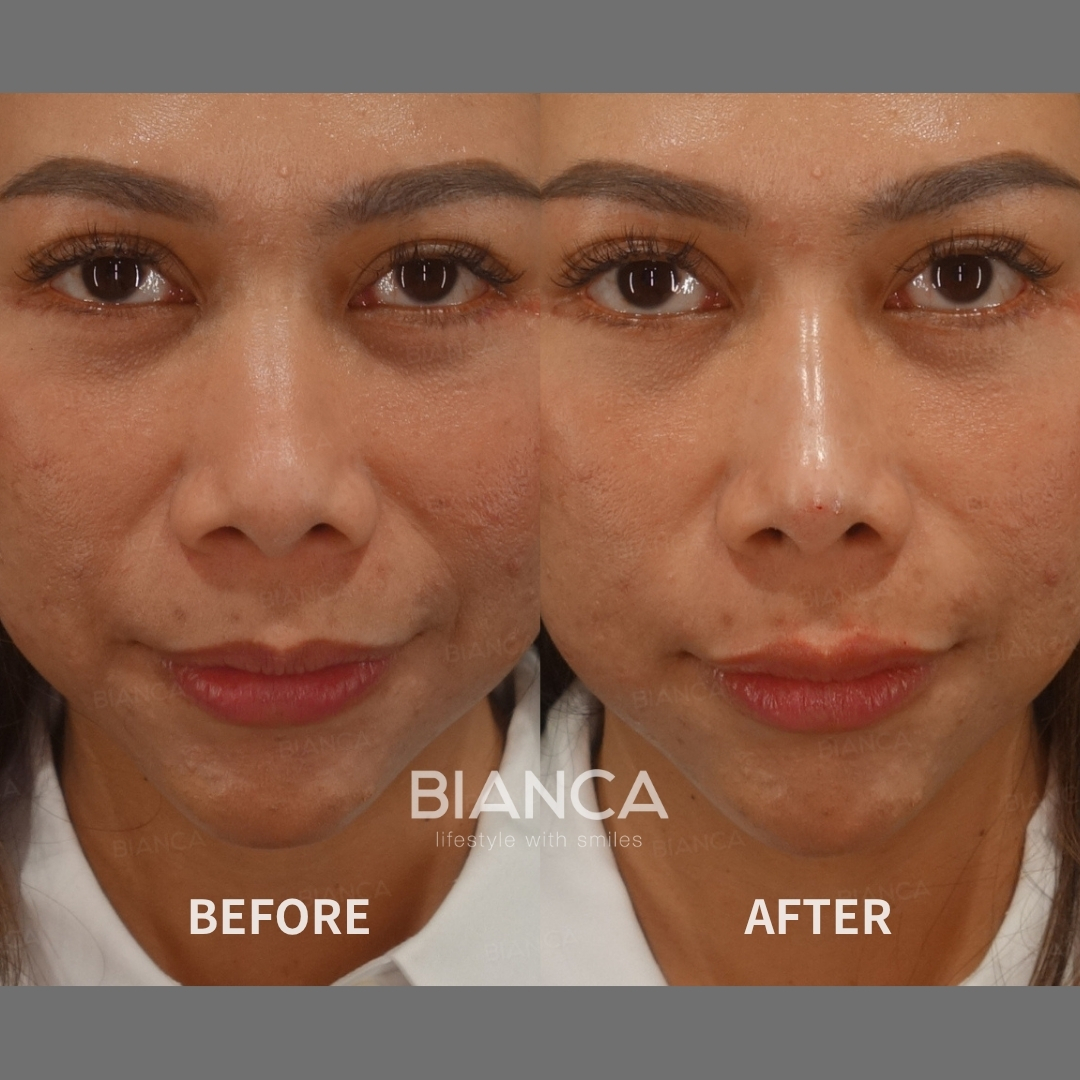 Left image: Before treatment / Right image: Just after Treatment details: Hyaluronic acid filler (nose), Neauvia Intense (1 mL), Hyaluronic acid filler (lips), Juvederm VOLBELLA (1 mL), Microcannula Cost (This will be self-funded treatment): ¥276,320 (tax inc.) Risks / side effects: Lump, asymmetry, hematoma, irregularities, infection, etc.