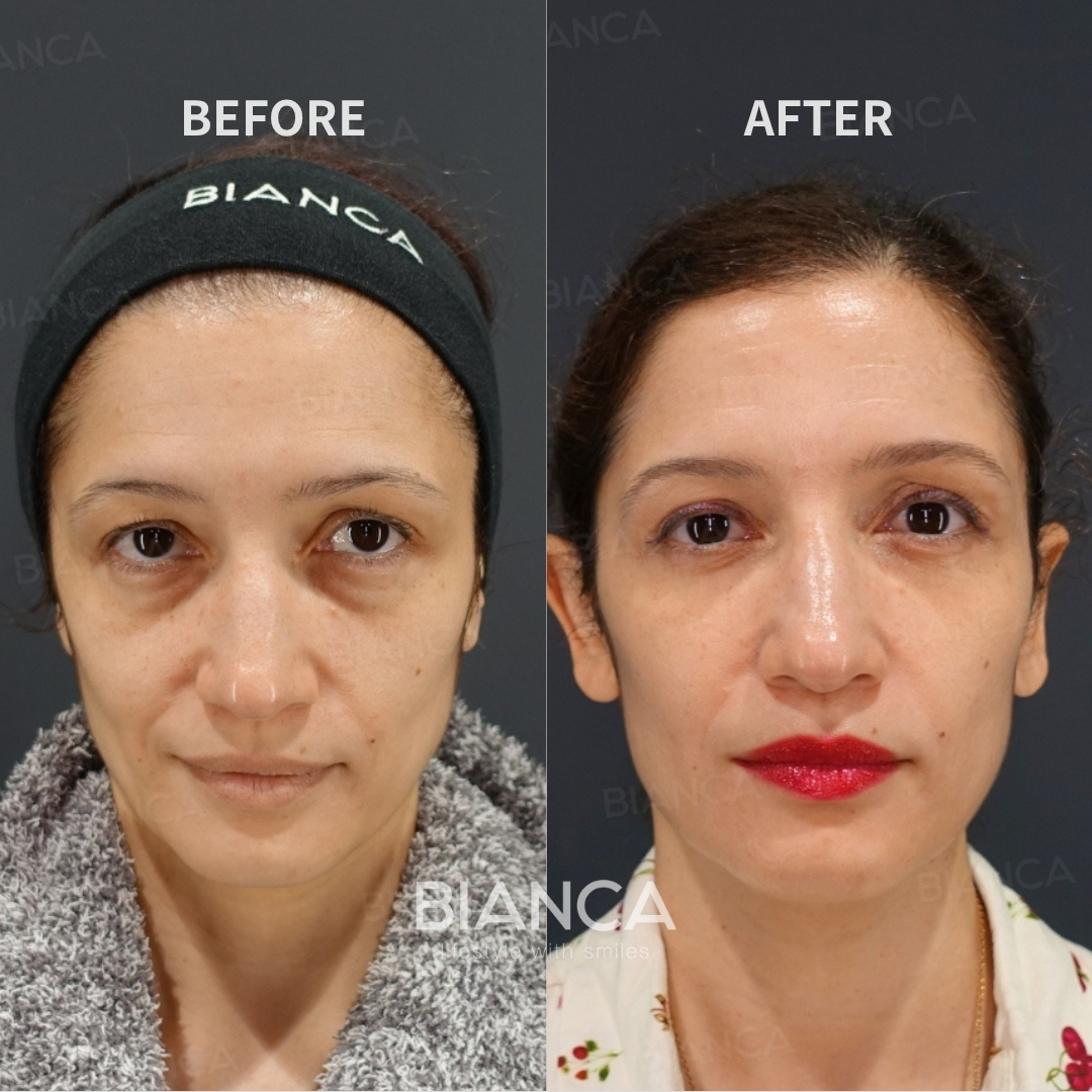 Left image: Before treatment / Right image: 3 months after Treatment details: Lower blepharoplasty (Hamra method), Upper blepharoplasty Cost (This will be self-funded treatment): ¥932,580 (tax inc.) Risks / side effects: Lump, asymmetry, hematoma, irregularities, infection, etc.