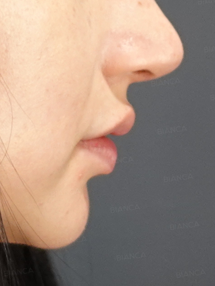 Side View Before