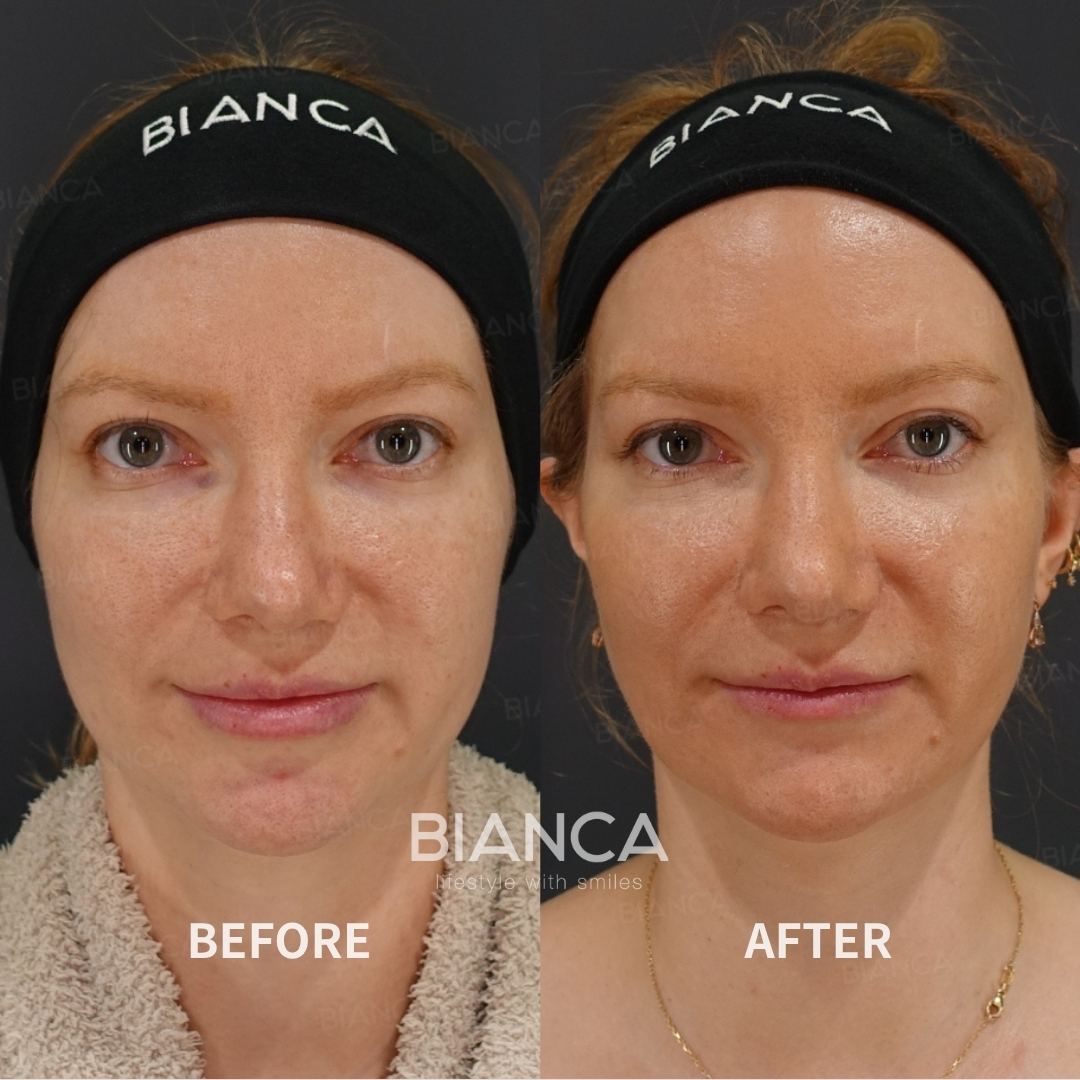 Left image: Before treatment / Right image: 1 month after Treatment details: Morpheus8 (submandibular), EmbraceRF (face tightening), Submental liposuction Cost (This will be self-funded treatment): ¥412,500 (tax inc.) Risks / side effects: Lump, asymmetry, hematoma, irregularities, infection, etc.