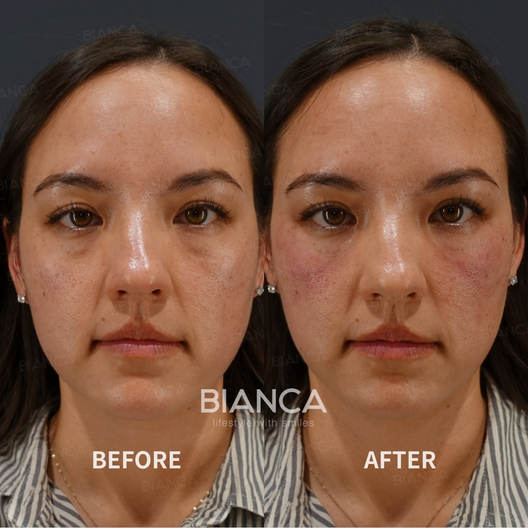 Left image: Before treatment / Right image: Just after Treatment details: Baby collagen (under eyes), Microcannula Cost (This will be self-funded treatment): ¥145,200 (tax inc.) Risks / side effects: Lump, asymmetry, hematoma, irregularities, infection, etc.