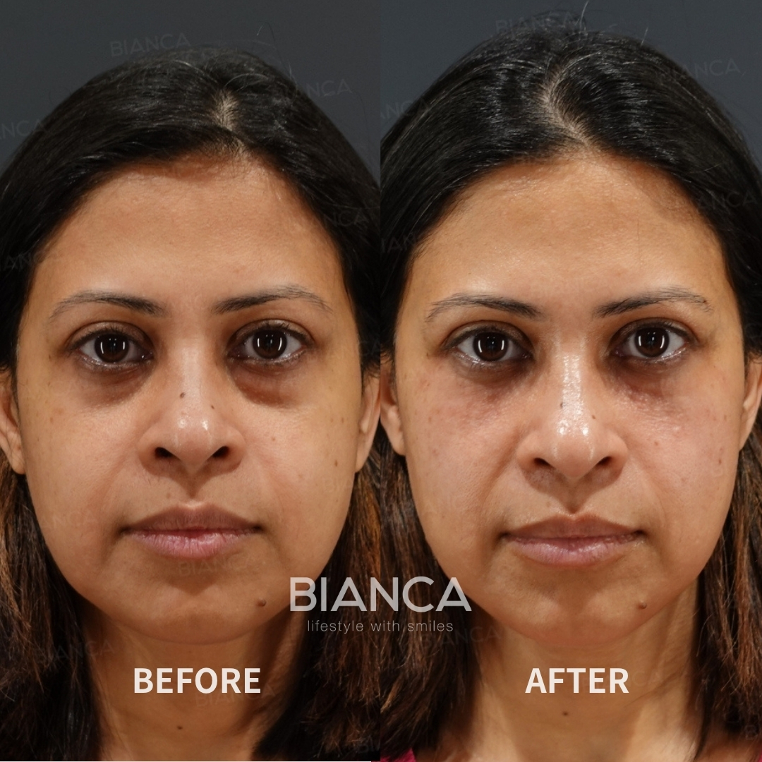 Left image: Before treatment / Right image: Just after Treatment details: Baby collagen (under eyes), Hyaluronic acid filler (tear trough), Juvederm VOLUMA XC, Microcannula Cost (This will be self-funded treatment): ¥256,520 (tax inc.) Risks / side effects: Lump, asymmetry, hematoma, irregularities, infection, etc.