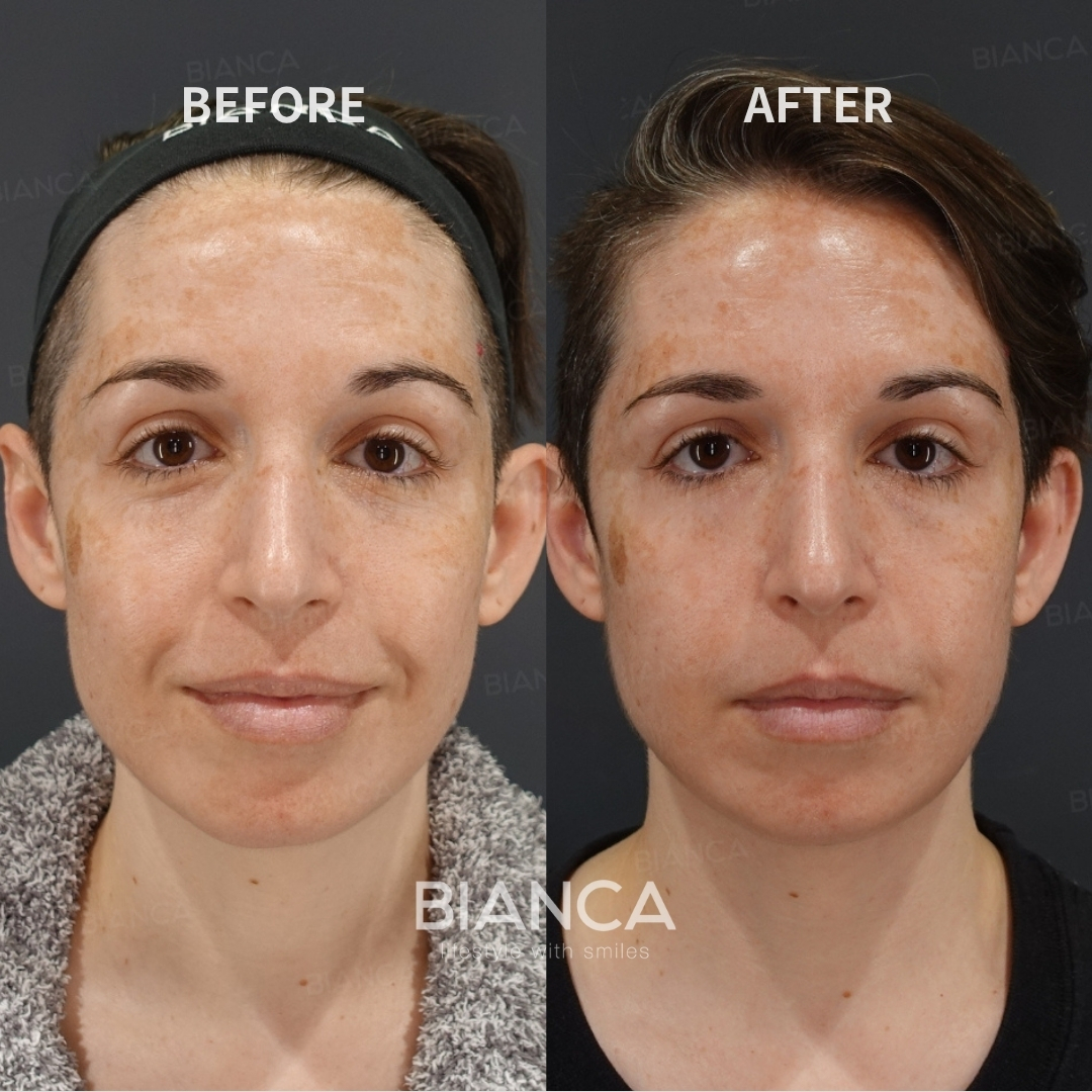 Left image: Before treatment / Right image: 3 months after Treatment details: Morpheus8 (submandibular), EmbraceRF (face tightening), Submental liposuction Cost (This will be self-funded treatment): ¥412,500 (tax inc.) Risks / side effects: Lump, asymmetry, hematoma, irregularities, infection, etc.