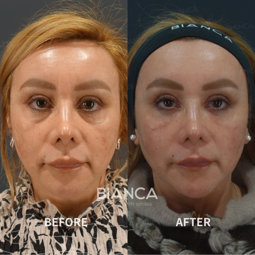 Left image: Before treatment / Right image: 2 weeks after Treatment details: Baby collagen injection (under eyes), Microcannula Cost (This will be self-funded treatment): ¥145,200 (tax inc.) Risks / side effects: Lump, asymmetry, hematoma, irregularities, infection, etc.