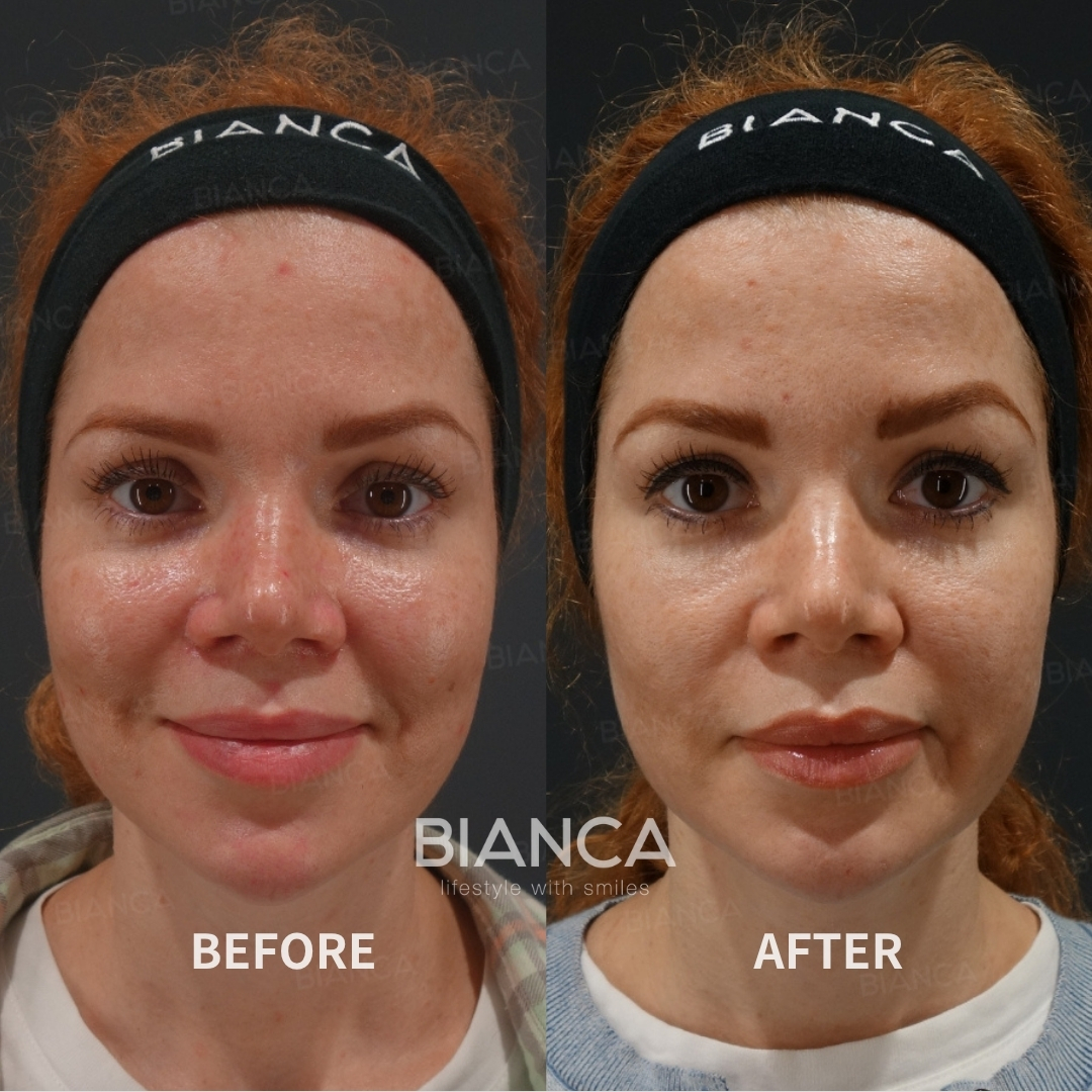 Left image: Before treatment / Right image: 2 weeks after Treatment details: Pico laser spot treatment (full face, unlimited) Cost (This will be self-funded treatment): ¥118,580 (tax inc.) Risks / side effects: Lump, asymmetry, hematoma, irregularities, infection, etc.