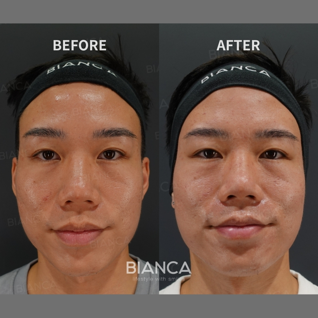 Left image: Before treatment / Right image: 2 weeks after Treatment details: Potenza RF microneedling (full face), Rejuran skin booster Cost (This will be self-funded treatment): ¥107,800 (tax inc.) Risks / side effects: Lump, asymmetry, hematoma, irregularities, infection, etc.