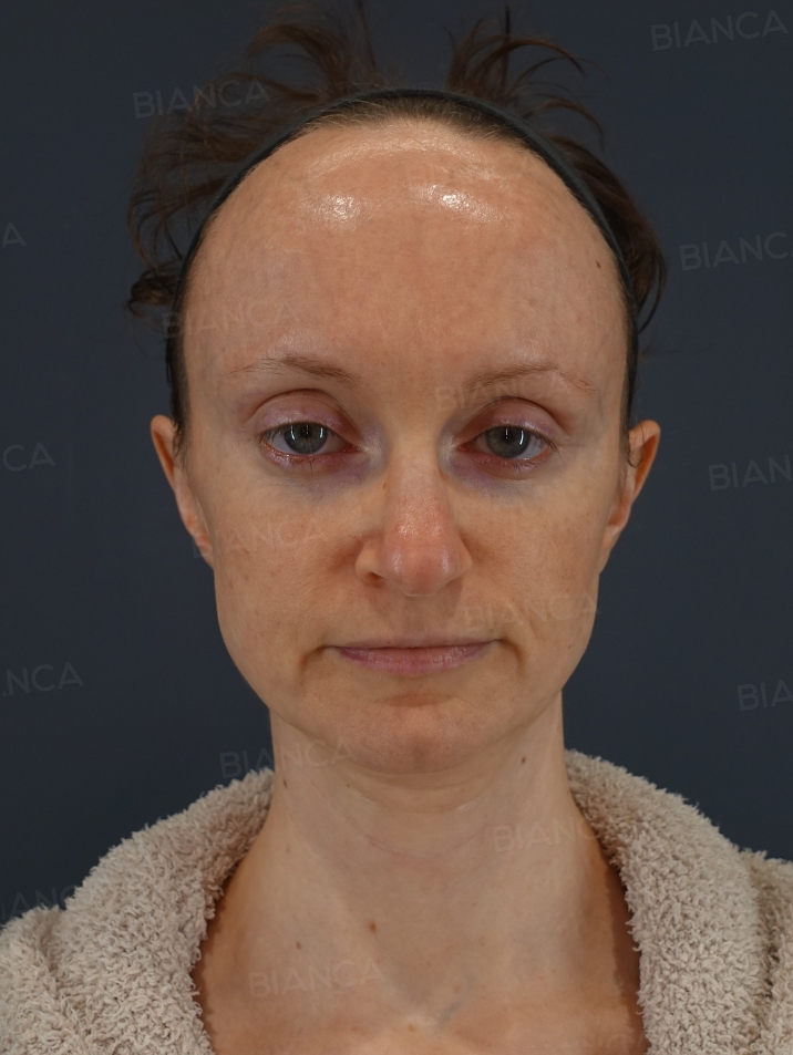 Nasal tip shaping、Nasal tip cartilage graft、Rhinoplasty