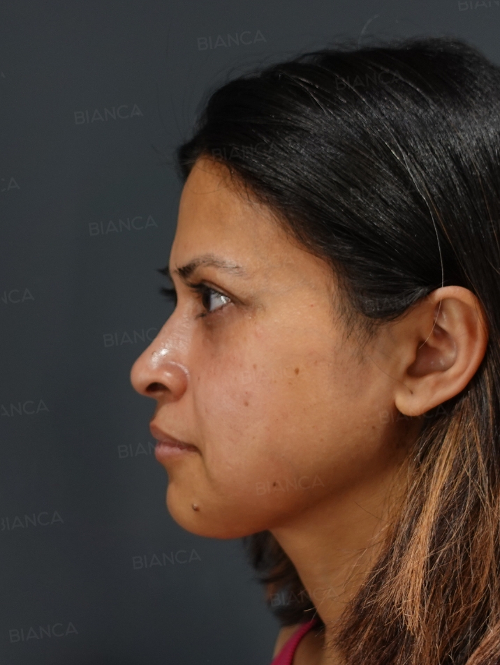 Baby Collagen + Hyaluronic Acid Injection for Under-Eye Dark Circles BIANCA in Tokyo, Japan