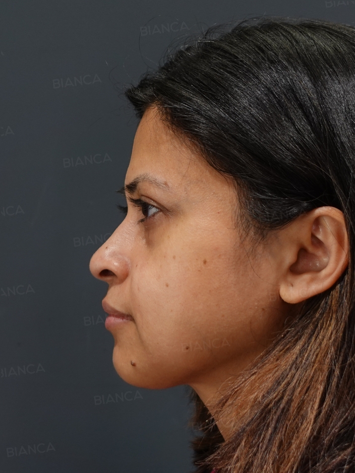 Baby Collagen + Hyaluronic Acid Injection for Under-Eye Dark Circles BIANCA in Tokyo, Japan