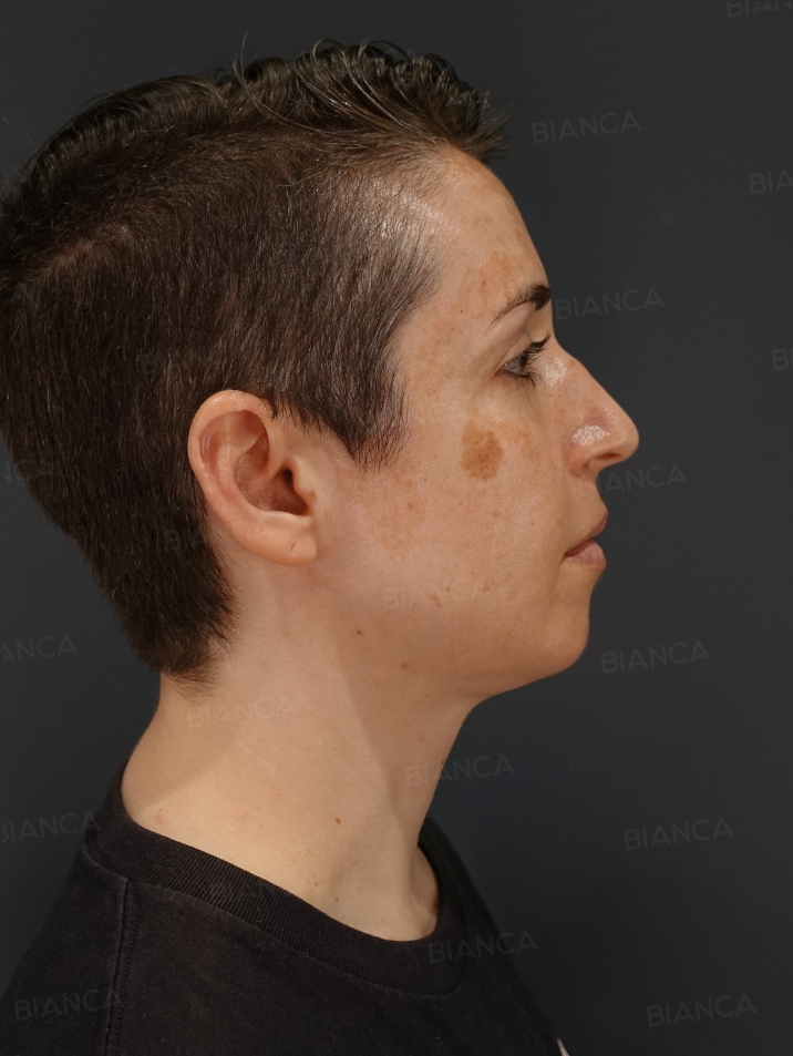 Side View After