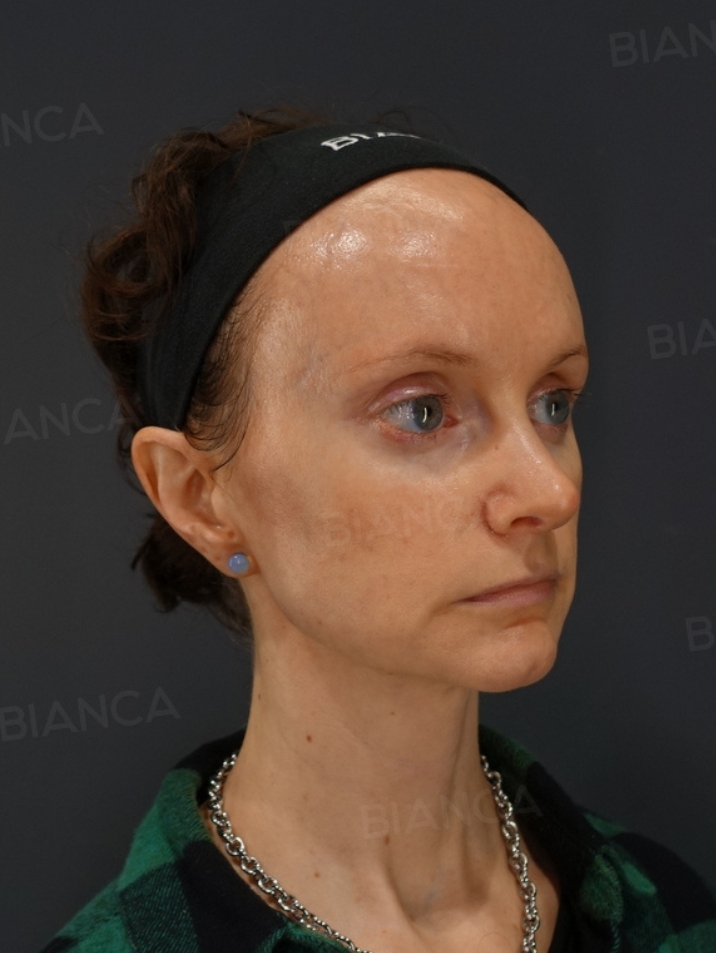 Nasal tip shaping、Nasal tip cartilage graft、Rhinoplasty